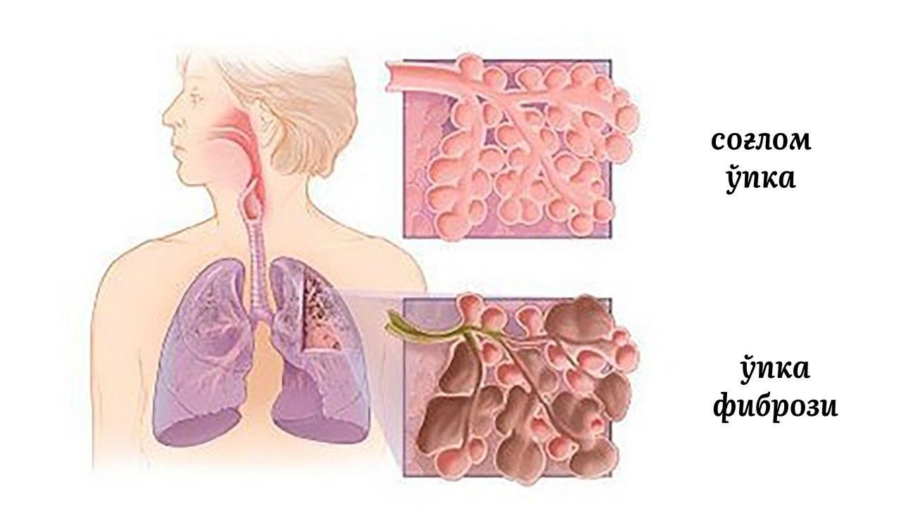 Картина фиброзных изменений. Легкие при фиброзе легких. Пневмосклероз и пневмофиброз. Пневмосклероз фиброз легких.