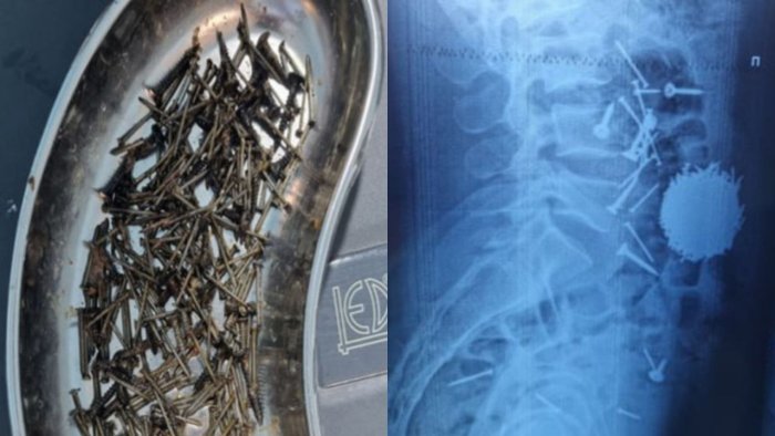 Самарқандда беморнинг қорнидан 200 грамм мих олиб ташланди