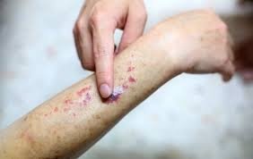 Аллергик васкулит: Қон томирлар нега яллиғланади?