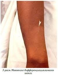 Ruminiyada 40 yildan ortiq vaqt ichida birinchi marta moxov kasalligi qayd etildi