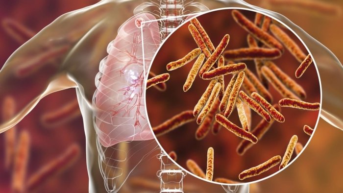 O‘zbekistonda sil va o‘pka kasalliklarini sun’iy intellekt orqali tashxislash yo‘lga qo‘yildi