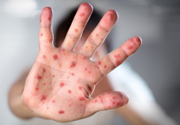 Bangladeshda yuzdan oshiq bola qizamiqdan vafot etdi