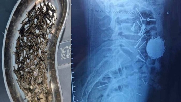 Шифокорлар самарқандлик бемор қорнидан 200 грамм мих олди