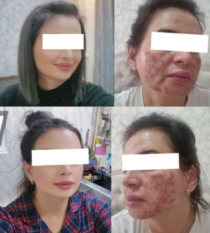 Гўзаллик салонида тиббий билимсиз ходим аёлнинг юзини 80% куйдириб юборди Гўзаллик салонида тиббий билимсиз ходим аёлнинг юзини 80% куйдириб юборди
