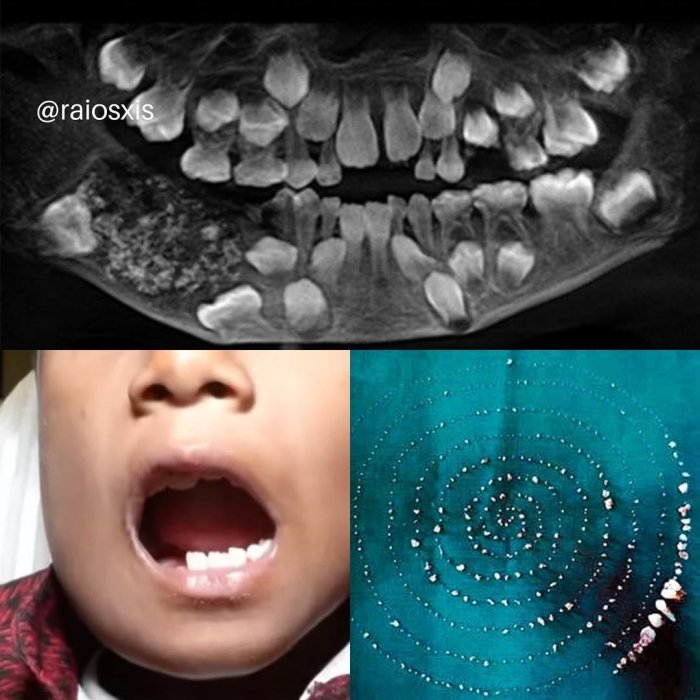 7 yoshli bolada 526 ta tish chiqdi