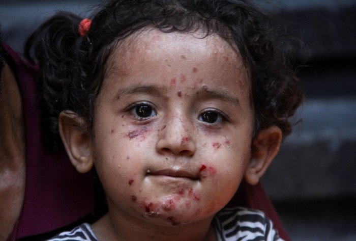 G‘azoda teri kasalliklari keskin ko‘paymoqda