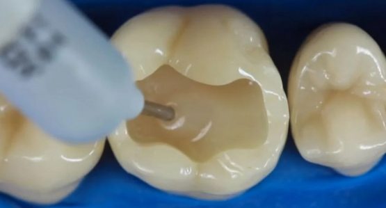 Zominda tish plombalari ishlab chiqaruvchi yangi korxona ish boshladi