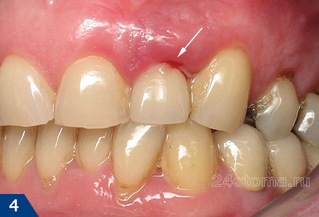 Oddiy tish kasali saraton keltirib chiqarishi mumkin