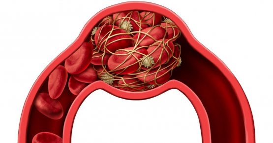 Коронавирус асоратида бош мияда тромб ҳосил бўлса, даволаш мумкинми?