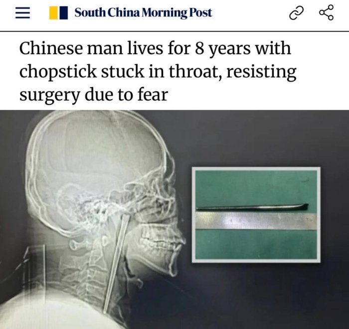 Xitoylik erkak 8 yil tomog‘ida ovqat tayoqchasi bilan yashagani ma’lum bo‘ldi