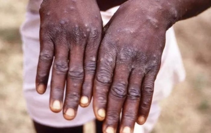 JSST mpox bilan kasallanish 22 oy ichida rekord darajaga chiqqanini ma’lum qildi