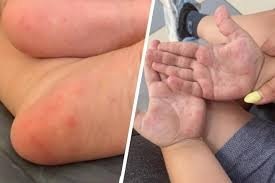 Yurtimizda bolalar orasida Koksaki virusi avj olayotgani haqidagi xabarlar asossiz! Yurtimizda bolalar orasida Koksaki virusi avj olayotgani haqidagi xabarlar asossiz!