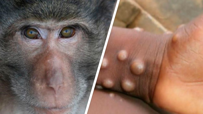 Dominikan Respublikasida maymunchechakning birinchi holati qayd etilgan
